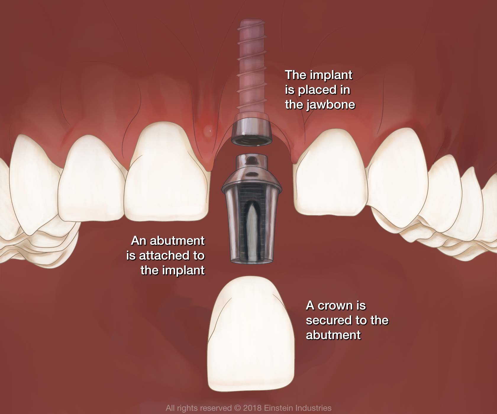 dental implant and crown