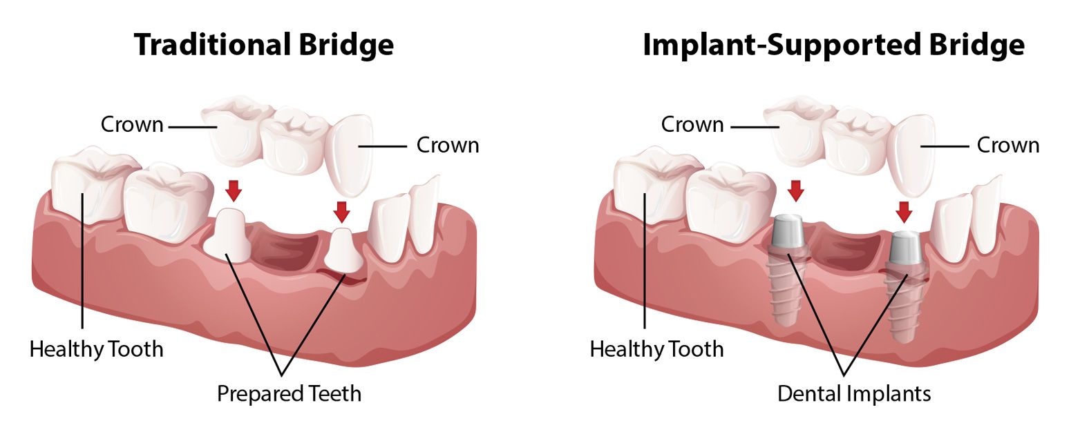 Side-by-side comparison of a traditional bridge and an implant-supported bridge.